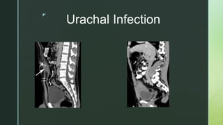 z
Urachal Infection
 