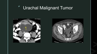 z
Urachal Malignant Tumor
 