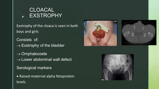 z
CLOACAL
EXSTROPHY
Exstrophy of the cloaca is seen in both
boys and girls
Consists of:
 Exstrophy of the bladder
 Omphalocoele
 Lower abdominal wall defect
Serological markers
 Raised maternal alpha fetoprotein
levels
 