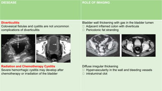 z
DIESEASE ROLE OF IMAGING
Diverticulitis
Colovesical fistulas and cystitis are not uncommon
complications of diverticulitis
Radiation and Chemotherapy Cystitis
Severe hemorrhagic cystitis may develop after
chemotherapy or irradiation of the bladder
Bladder wall thickening with gas in the bladder lumen
Adjacent inflamed colon with diverticula
Pericolonic fat stranding
Diffuse irregular thickening
Hypervascularity in the wall and bleeding vessels
intraluminal clot
 