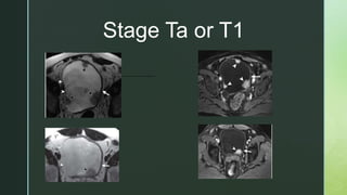 Stage Ta or T1
 