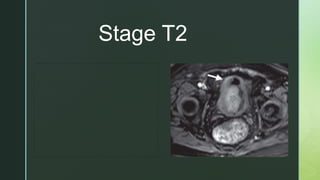Stage T2
 