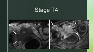Stage T4
 