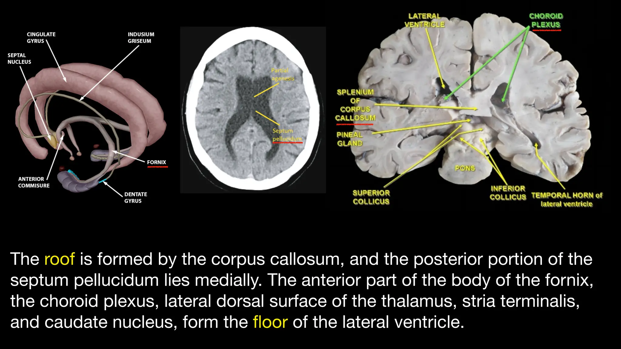 Ventricles_of_the_brain_The ventricles of the brain are a communicating