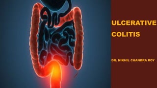 ULCERATIVE
COLITIS
DR. NIKHIL CHANDRA ROY
 