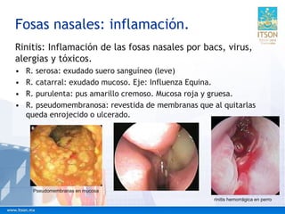 Rinitis: Inflamación de las fosas nasales por bacs, virus,
alergias y tóxicos.
• R. serosa: exudado suero sanguíneo (leve)
• R. catarral: exudado mucoso. Eje: Influenza Equina.
• R. purulenta: pus amarillo cremoso. Mucosa roja y gruesa.
• R. pseudomembranosa: revestida de membranas que al quitarlas
queda enrojecido o ulcerado.
Fosas nasales: inflamación.
rinitis hemorrágica en perro
Pseudomembranas en mucosa
 