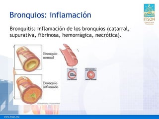 Bronquios: inflamación
Bronquitis: Inflamación de los bronquios (catarral,
supurativa, fibrinosa, hemorrágica, necrótica).
 