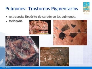 Pulmones: Trastornos Pigmentarios
• Antracosis: Depósito de carbón en los pulmones.
• Melanosis.
 
