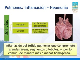 Pulmones: inflamación = NeumoníaDosvías
Vascular
N. Exudativa
(alveolares)
Celular
N. Proliferativa
(intersticiales)
Inflamación del tejido pulmonar que compromete
grandes áreas, segmentos o lóbulos, y, por lo
común, de manera más o menos homogénea..
 