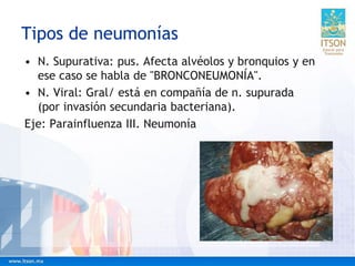 Tipos de neumonías
• N. Supurativa: pus. Afecta alvéolos y bronquios y en
ese caso se habla de "BRONCONEUMONÍA".
• N. Viral: Gral/ está en compañía de n. supurada
(por invasión secundaria bacteriana).
Eje: Parainfluenza III. Neumonía
 