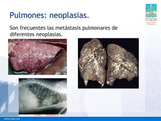 Pulmones: neoplasias.
Son frecuentes las metástasis pulmonares de
diferentes neoplasias.
 
