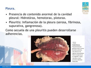 Pleura.
• Presencia de contenido anormal de la cavidad
pleural: Hidrotórax, hemotorax, píotorax.
• Pleuritis: Inflamación de la pleura (serosa, fibrinosa,
supurativa, gangrenosa).
Como secuela de una pleuritis pueden desarrollarse
adherencias.
 