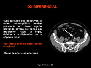•Los cálculos que obstruyen la
unión urétero-piélica pueden
presentar un dolor agudo
profundo severo del flanco sin
irradiación hacia la ingle,
debido a la distensión de la
cápsula renal.
•En forma crónica dolor sordo
ocasional
•Dolor de aparición nocturna
DX DIFERENCIAL
Klgo. David López DC
 