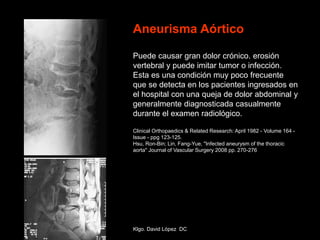 Aneurisma Aórtico
Puede causar gran dolor crónico. erosión
vertebral y puede imitar tumor o infección.
Esta es una condición muy poco frecuente
que se detecta en los pacientes ingresados ​​en
el hospital con una queja de dolor abdominal y
generalmente diagnosticada casualmente
durante el examen radiológico.
Clinical Orthopaedics & Related Research: April 1982 - Volume 164 -
Issue - ppg 123-125.
Hsu, Ron-Bin; Lin, Fang-Yue, "Infected aneurysm of the thoracic
aorta" Journal of Vascular Surgery 2008 pp. 270-276
Klgo. David López DC
 