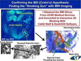 Confirming the IBD (Crohn’s) Hypothesis:
Finding the ―Smoking Gun‖ with MRI Imaging
Liver

Transverse Colon

Small Intestine

I Obtained the MRI Slices
From UCSD Medical Services
and Converted to Interactive 3D
Working With
Calit2 Staff & DeskVOX Software
Descending Colon

MRI Jan 2012
Cross Section

Diseased Sigmoid Colon

Major Kink

Sigmoid Colon
Threading Iliac Arteries

 