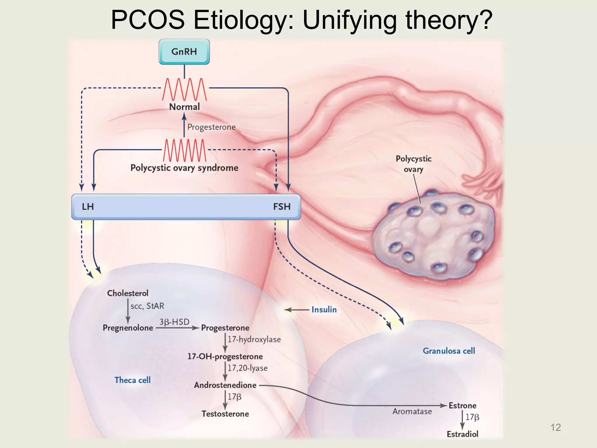 Polycystic Ovary Syndrome (PCOS) | PDF