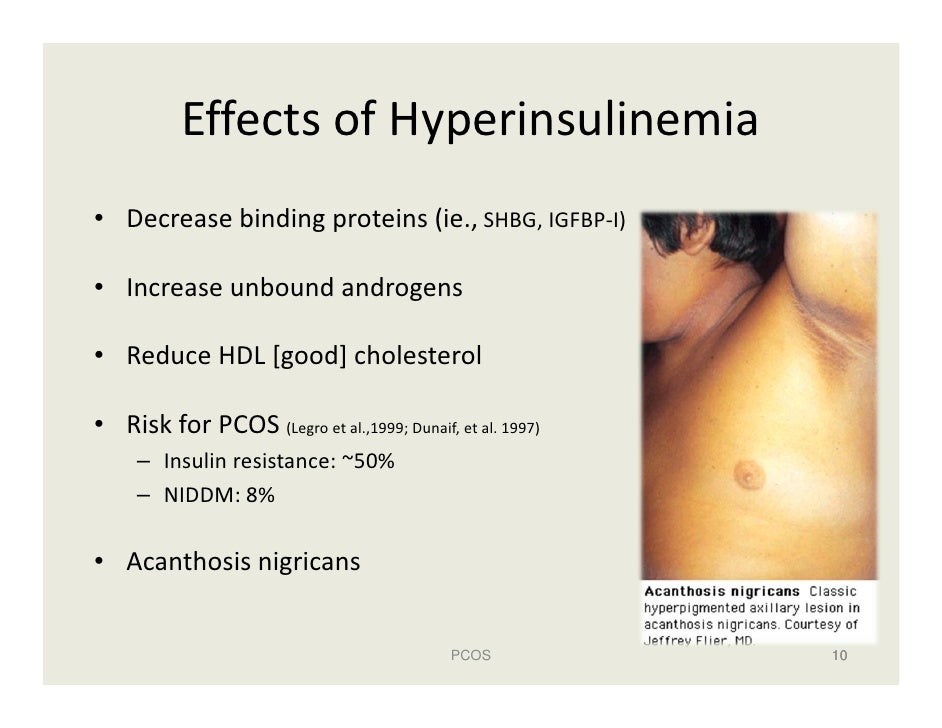 insulin how reduce resistance Ovary Polycystic (PCOS) Syndrome
