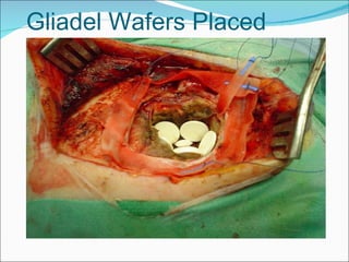 Gliadel Wafers Placed 