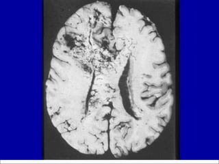Glioblastoma:  post-mortem 