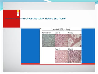 GRP78 LEVELS IN GLIOBLASTOMA TISSUE SECTIONS 