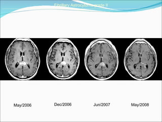 May/2006 Dec/2006 Fibrillary Astrocytoma grade II ______________________________________________________________________________________________________________________________________   May/2008 Jun/2007 