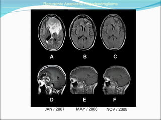 JAN / 2007 MAY / 2008 Recurrente Anaplastic Oligodendroglioma ______________________________________________________________________________________________________________________________________ NOV / 2008 