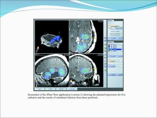 Screenshot of the iPlan! flow application (version 2) showing the planned trajectories for five catheters and the results of simulated infusion from these positions. 