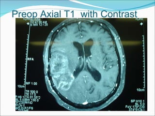 Preop Axial T1  with Contrast 