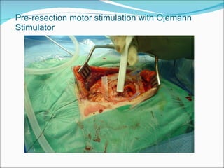 Pre-resection motor stimulation with Ojemann Stimulator 