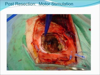 Post Resection:  Motor Stimulation 
