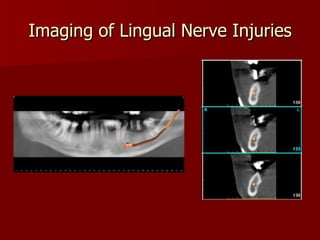 Imaging of Lingual Nerve Injuries CT 