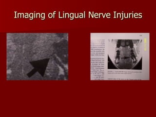 Imaging of Lingual Nerve Injuries Miloro M, Halkias LE, Slone HW, Chakeres DW. Assessment of the Linual Nerve in the Third Molar  Region Using Magnetic Resonance Imaging.  J Oral Maxillofacial Surgery , 1997; 55:134-137. MRI MRI 