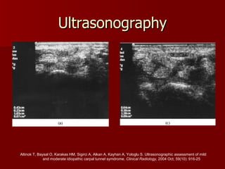 Ultrasonography Altinok T, Baysal O, Karakas HM, Sigirci A, Alkan A, Kayhan A, Yologlu S. Ultrasonographic assessment of mild  and moderate idiopathic carpal tunnel symdrome.  Clinical Radiology,  2004 Oct; 59(10): 916-25 