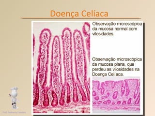Doença Celíaca Prof. Andretty Coimbra 