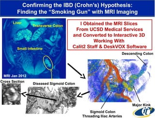 Confirming the IBD (Crohn’s) Hypothesis:
Finding the “Smoking Gun” with MRI Imaging
Liver

Transverse Colon

Small Intestine

I Obtained the MRI Slices
From UCSD Medical Services
and Converted to Interactive 3D
Working With
Calit2 Staff & DeskVOX Software
Descending Colon

MRI Jan 2012
Cross Section

Diseased Sigmoid Colon

Major Kink
Sigmoid Colon
Threading Iliac Arteries

 