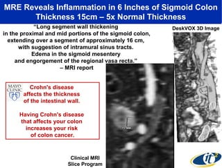 MRE Reveals Inflammation in 6 Inches of Sigmoid Colon
Thickness 15cm – 5x Normal Thickness
“Long segment wall thickening
in the proximal and mid portions of the sigmoid colon,
extending over a segment of approximately 16 cm,
with suggestion of intramural sinus tracts.
Edema in the sigmoid mesentery
and engorgement of the regional vasa recta.”
– MRI report
Crohn's disease
affects the thickness
of the intestinal wall.
Having Crohn's disease
that affects your colon
increases your risk
of colon cancer.

Clinical MRI
Slice Program

DeskVOX 3D Image

 