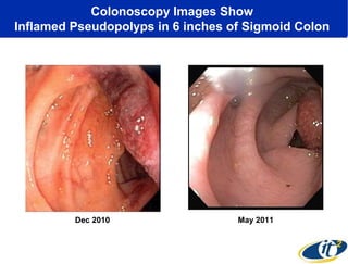 Colonoscopy Images Show
Inflamed Pseudopolyps in 6 inches of Sigmoid Colon

Dec 2010

May 2011

 