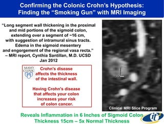 Confirming the Colonic Crohn’s Hypothesis:
Finding the “Smoking Gun” with MRI Imaging
“Long segment wall thickening in the proximal
and mid portions of the sigmoid colon,
extending over a segment of ~16 cm,
with suggestion of intramural sinus tracts.
Edema in the sigmoid mesentery
and engorgement of the regional vasa recta.”
– MRI report, Cynthia Santillan, M.D. UCSD
Jan 2012
Crohn's disease
affects the thickness
of the intestinal wall.
Having Crohn's disease
that affects your colon
increases your risk
of colon cancer.

Clinical MRI Slice Program

Reveals Inflammation in 6 Inches of Sigmoid Colon
Thickness 15cm – 5x Normal Thickness

 