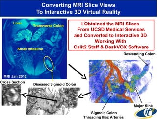 Converting MRI Slice Views
To Interactive 3D Virtual Reality
Liver

Transverse Colon

Small Intestine

I Obtained the MRI Slices
From UCSD Medical Services
and Converted to Interactive 3D
Working With
Calit2 Staff & DeskVOX Software
Descending Colon

MRI Jan 2012
Cross Section

Diseased Sigmoid Colon

Major Kink
Sigmoid Colon
Threading Iliac Arteries

 