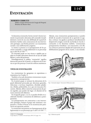 1
EVENTRACIÓN
ROBERTO CERRUTTI
Médico cirujano del Servicio de Cirugía del Hospital
Británico de Buenos Aires.
Se denomina eventración, hernia ventral o hernia inci-
sional a la protrusión subcutánea del contenido intraab-
dominal a través de una zona debilitada de la pared ab-
dominal o lumbar como consecuencia de una interven-
ción quirúrgica, una brecha posterior a un traumatismo
cerrado o una malformación congénita.
La misma se presenta en el postoperatorio de los pa-
cientes sometidos a cirugía abdominal en un porcentaje
que va del 3% al 13%8-15-14
.
El contenido puede ser una víscera o epiplón que se
aloja en el tejido subcutáneo dentro de un saco de tejido
fibroso y restos del peritoneo.
Etimológicamente la palabra ¨eventración¨ significa
destrucción parcial de la pared y se diferencia de la her-
nia en que ésta protruye a través de orificios anatómicos.
TIPOS DE EVENTRACIÓN
Las eventraciones las agrupamos en espontáneas o
traumáticas (ver Cuadro 1).
También se las suele denominar eventraciones no pos-
toperatorias y postoperatorias.
En el primer grupo se incluyen las alteraciones de la
pared abdominal provocadas por afecciones generales,
infecciosas o nerviosas (raquitismo, obesidad, paludis-
mo, tifoidea, poliomielitis, etc.), que son muy poco fre-
cuentes. Además, deben citarse las consecuencias de par-
tos seguidos, que pueden dar lugar a la diastásis de los
rectos anteriores del abdomen.
En el segundo grupo, a su vez, se pueden dividir en ac-
cidentales (heridas o contusiones de abdomen) y posto-
peratorias.
Las postoperatorias son consecutivas a una interven-
ción quirúrgica, forman el grupo más numeroso e im-
portante y revelan el fracaso en la reconstrucción parie-
tal de una operación anterior.
La eventración está presente en el postoperatorio de las
laparotomías en un porcentaje que va del 3 al 13%8-15-16
.
Además, estas eventraciones postoperatorias se pueden
dividir de acuerdo al momento de su aparición en agu-
das y crónicas. Las agudas se producen inmediatamente
después de la cirugía a través de una herida en vías de ci-
catrización; se las denomina también, "eventraciones
postoperatorias inmediatas¨ con evisceración o sin ella.
Las crónicas se presentan alejadas de la operación por un
debilitamiento progresivo de la cicatriz, o una inmedia-
I-147
CERRUTTI R; Eventración.
Cirugía Digestiva, F. Galindo. www.sacd.org.ar, 2009; I-147, pág. 1-16.
Fig. 1. Eventración Aguda - Evisceración (Dehiscencia total).
Fig. 2. Dehiscencia parcial.
 
