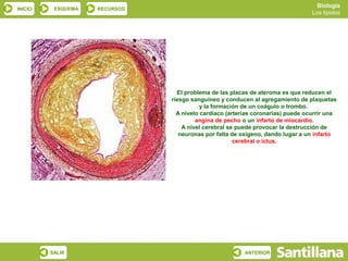 Biología
INICIO    ESQUEMA   RECURSOS
                                                                                 Los lípidos




                                 El problema de las placas de ateroma es que reducen el
                               riesgo sanguíneo y conducen al agregamiento de plaquetas
                                          y la formación de un coágulo o trombo.
                                 A nivelo cardíaco (arterias coronarias) puede ocurrir una
                                        angina de pecho o un infarto de miocardio.
                                   A nivel cerebral se puede provocar la destrucción de
                                  neuronas por falta de oxígeno, dando lugar a un infarto
                                                      cerebral o ictus.




         SALIR                                           ANTERIOR
 