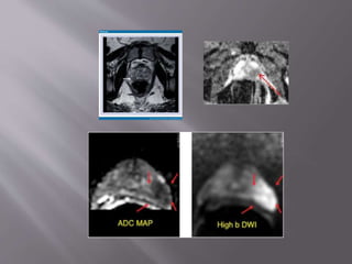 Role of diffusion weighted magnetic resonance imaging in | PPTX