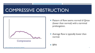 COMPRESSIVE OBSTRUCTION
 Pattern of flow seems normal til Qmax
(lower than normal) with a terminal
prolongation.
 Average flow is typically lower than
normal.
 BPH
13
DEPT OF UROLOGY, GRH AND KMC, CHENNAI.
 