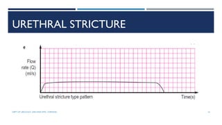 URETHRAL STRICTURE
16
DEPT OF UROLOGY, GRH AND KMC, CHENNAI.
 