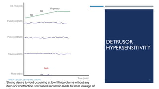 DETRUSOR
HYPERSENSITIVITY
Strong desire to void occurring at low filling volume without any
detrusor contraction. Increased sensation leads to small leakage of
53
DEPT OF UROLOGY, GRH AND KMC, CHENNAI.
 