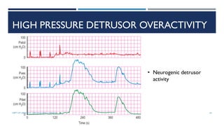 HIGH PRESSURE DETRUSOR OVERACTIVITY
• Neurogenic detrusor
activity
63
DEPT OF UROLOGY, GRH AND KMC, CHENNAI.
 