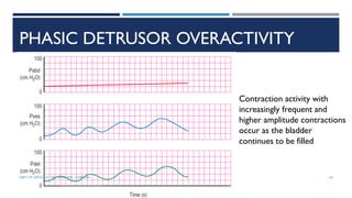 PHASIC DETRUSOR OVERACTIVITY
Contraction activity with
increasingly frequent and
higher amplitude contractions
occur as the bladder
continues to be filled
64
DEPT OF UROLOGY, GRH AND KMC, CHENNAI.
 