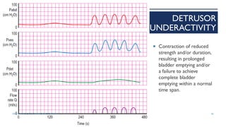 DETRUSOR
UNDERACTIVITY
 Contraction of reduced
strength and/or duration,
resulting in prolonged
bladder emptying and/or
a failure to achieve
complete bladder
emptying within a normal
time span.
82
DEPT OF UROLOGY, GRH AND KMC, CHENNAI.
 