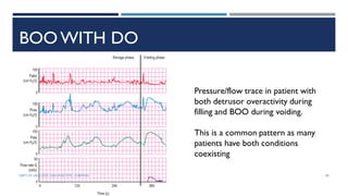 BOO WITH DO
Pressure/flow trace in patient with
both detrusor overactivity during
filling and BOO during voiding.
This is a common pattern as many
patients have both conditions
coexisting
89
DEPT OF UROLOGY, GRH AND KMC, CHENNAI.
 