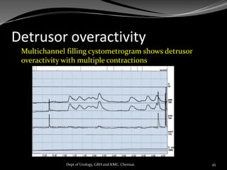 Detrusor overactivity
Multichannel filling cystometrogram shows detrusor
overactivity with multiple contractions
45
Dept of Urology, GRH and KMC, Chennai.
 